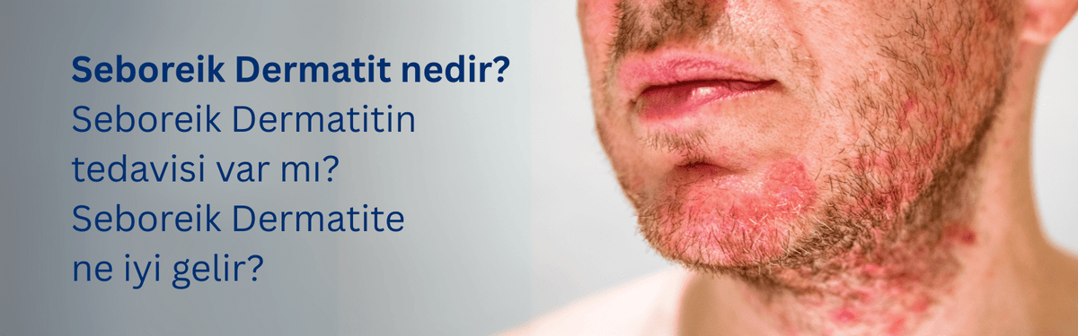 Seboreik Dermatit Hakkında Bilinmesi Gerekenler