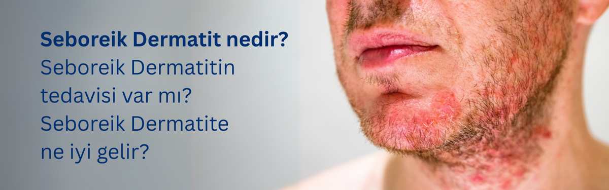 Seboreik Dermatit Hakkında Bilinmesi Gerekenler: Belirtiler, Nedenler ve Çözümler