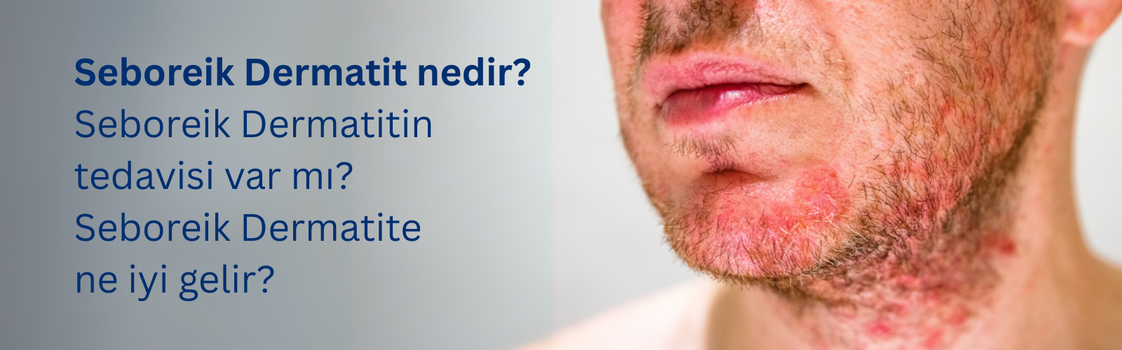 Seboreik Dermatit Hakkında Bilinmesi Gerekenler: Belirtiler, Nedenler ve Çözümler