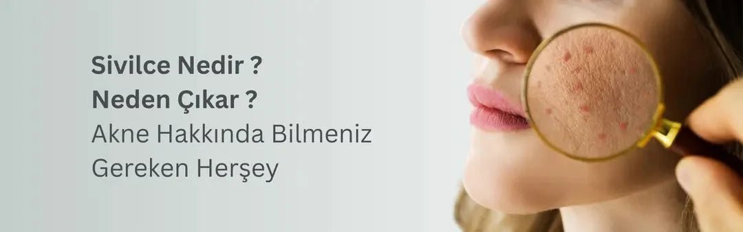 Sivilce Neden Çıkar? Akne Hakkında Bilmeniz Gerekenler