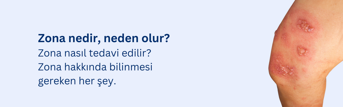 Zona Hastalığı Nedir? Zona Neden Olur?