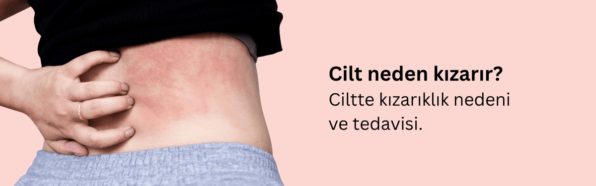Ciltte Kızarıklık Neden Olur? Yüzde Kızarıklık Neden Olur?