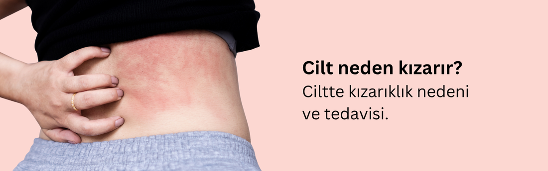 Ciltte Kızarıklık Neden Olur? Yüzde Kızarıklık Neden Olur? Deride Kabartı, Kızarıklık ve Kaşıntı Nedenleri