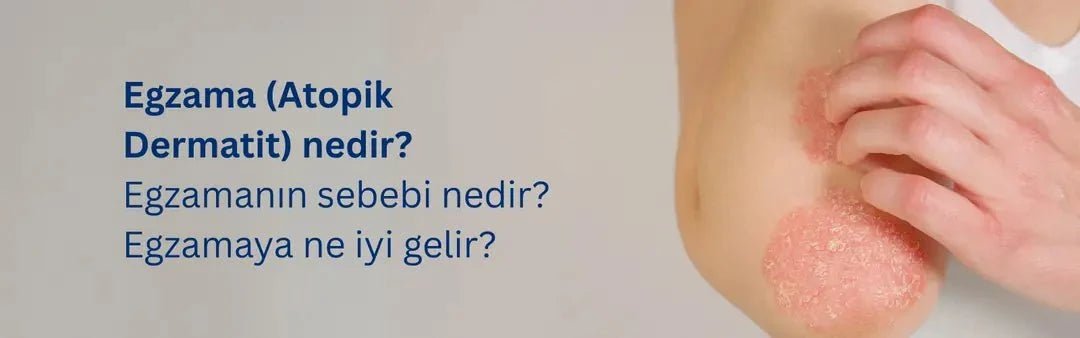 Egzama Nedir? Belirtileri, Nedenleri ve Tedavi Yöntemleri