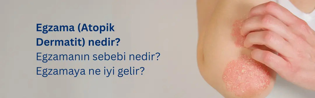 Egzama Nedir? Belirtileri, Nedenleri ve Tedavi Yöntemleri Hakkında Bilmeniz Gerekenler