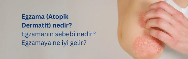 Egzama Nedir? Belirtileri, Nedenleri ve Tedavi Yöntemleri Hakkında Bilmeniz Gerekenler