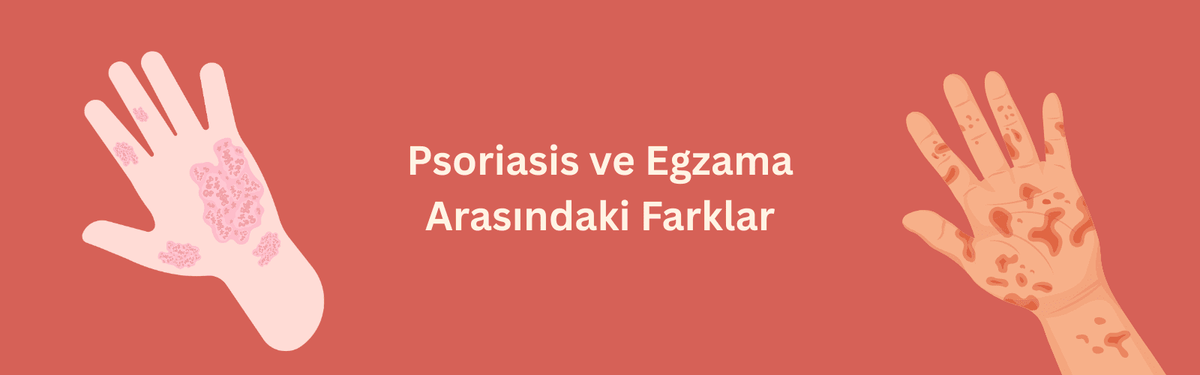 Egzama ve Sedef Arasındaki Farklar Nelerdir?