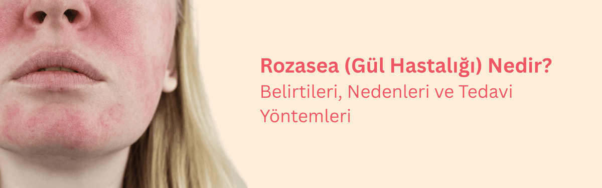 Gül Hastalığı (Rozasea) Nedir? Baş Etmenin Yolları