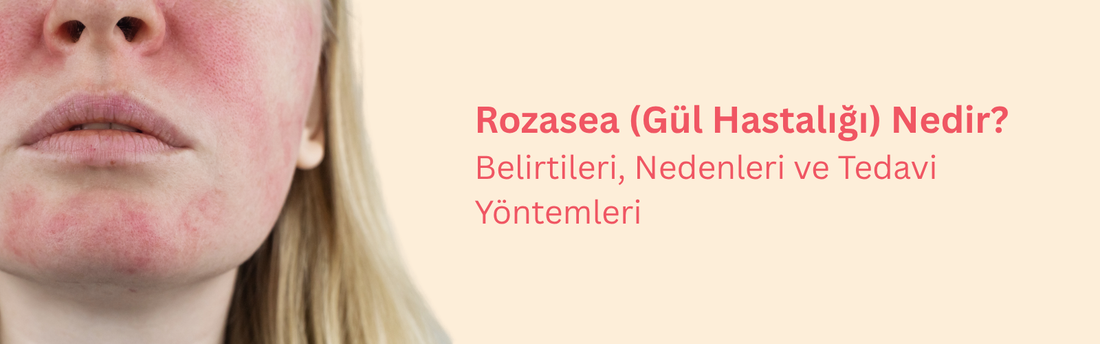 Gül Hastalığı (Rozasea) Nedir? Neden Olur? Nasıl Geçer?